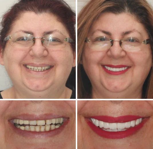 Denture Set Moldable Custom Fit Upper & Lower