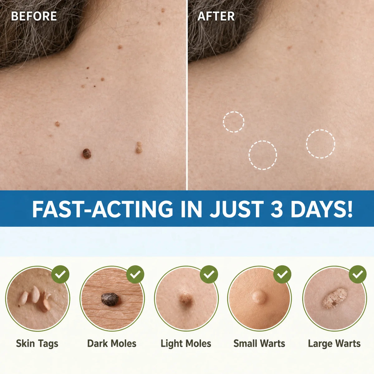 Skin Tag Removal Patches Pain-Free & Non-Invasive Skin-Friendly