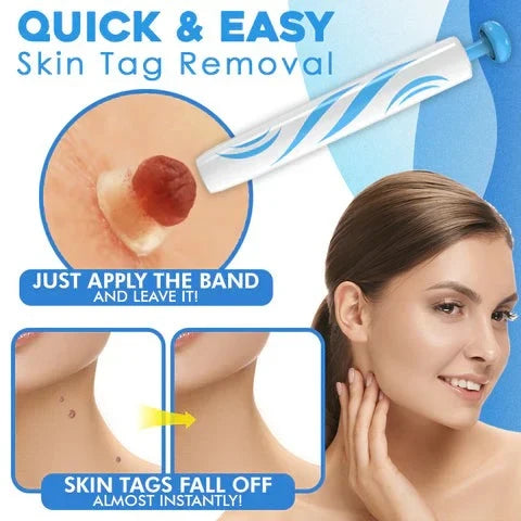 Skin Tag Remover Handheld Guided Loop Two Sizes