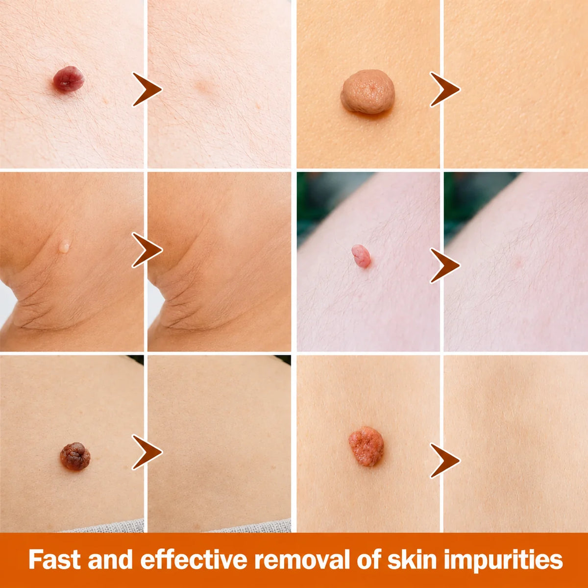 Skin Tag Remover Precision Pen Face & Body
