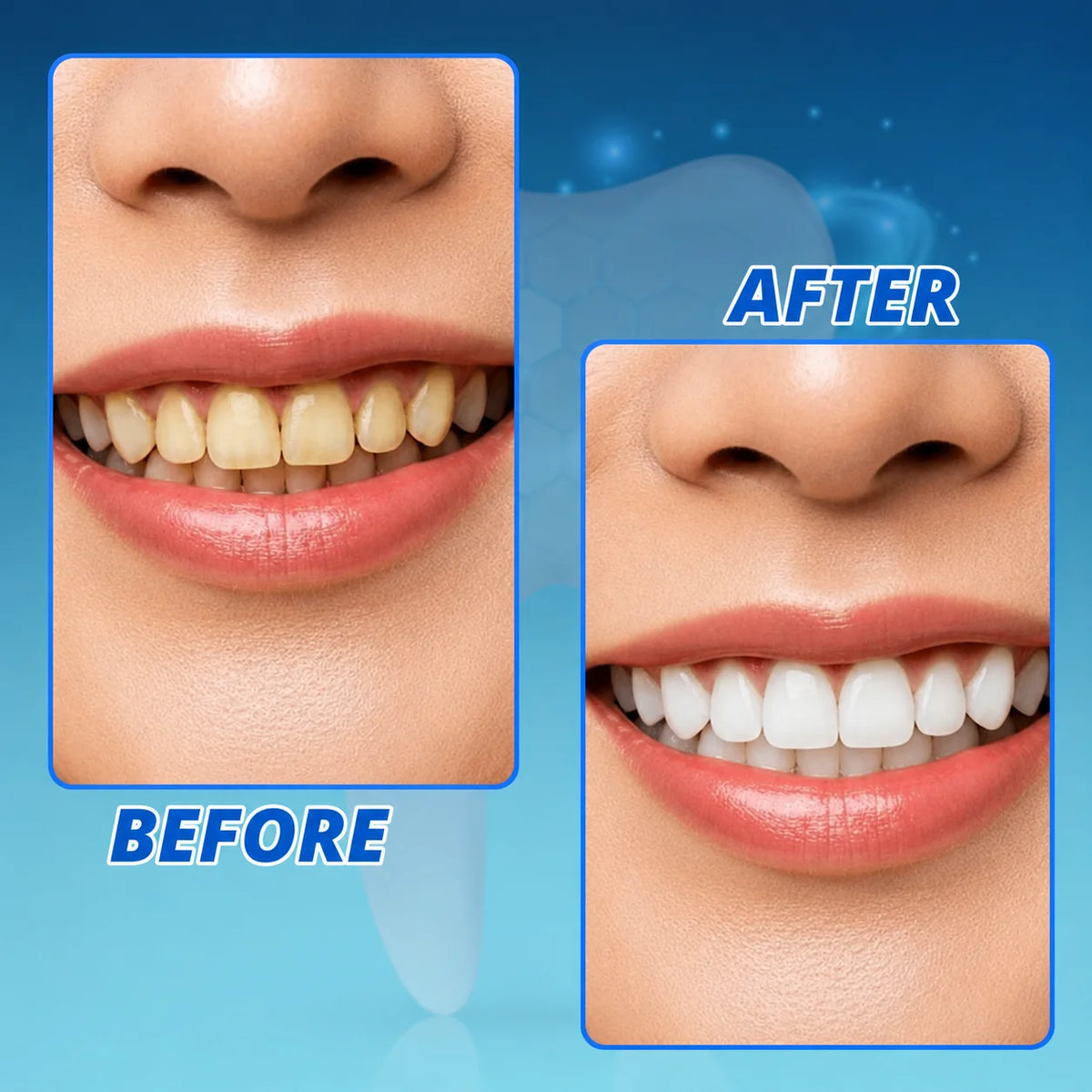 Teeth Whitening Pen Gentle Peroxide & Precision Brush