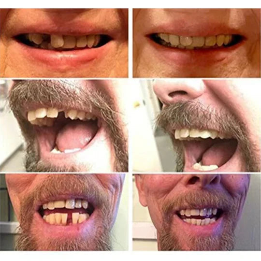 Temporary Dental Veneers Natural Look & Comfortable Fit