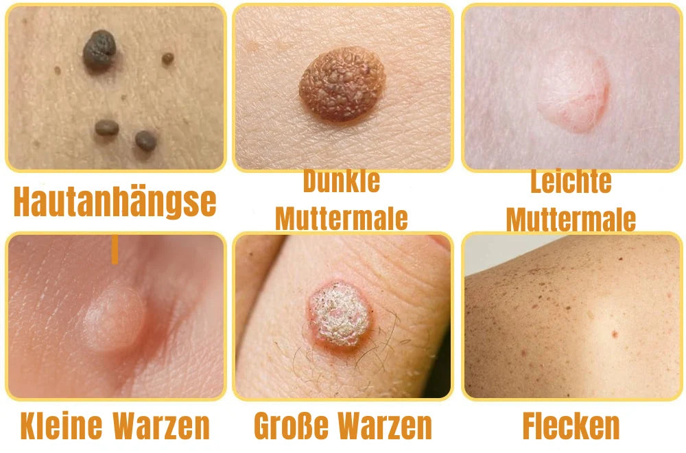 Wart & Skin Tag Remover Pain-Free Spray 20ml