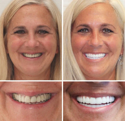 Denture Set Moldable Custom Fit Upper & Lower