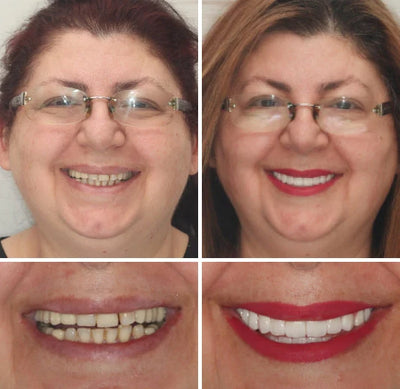 Denture Set Moldable Custom Fit Upper & Lower