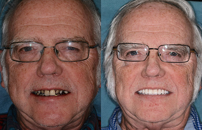 Denture Set Moldable Custom Fit Upper & Lower