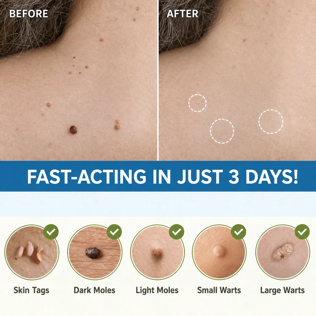 Skin Tag Removal Patches Gentle & Discreet for Daily Wear
