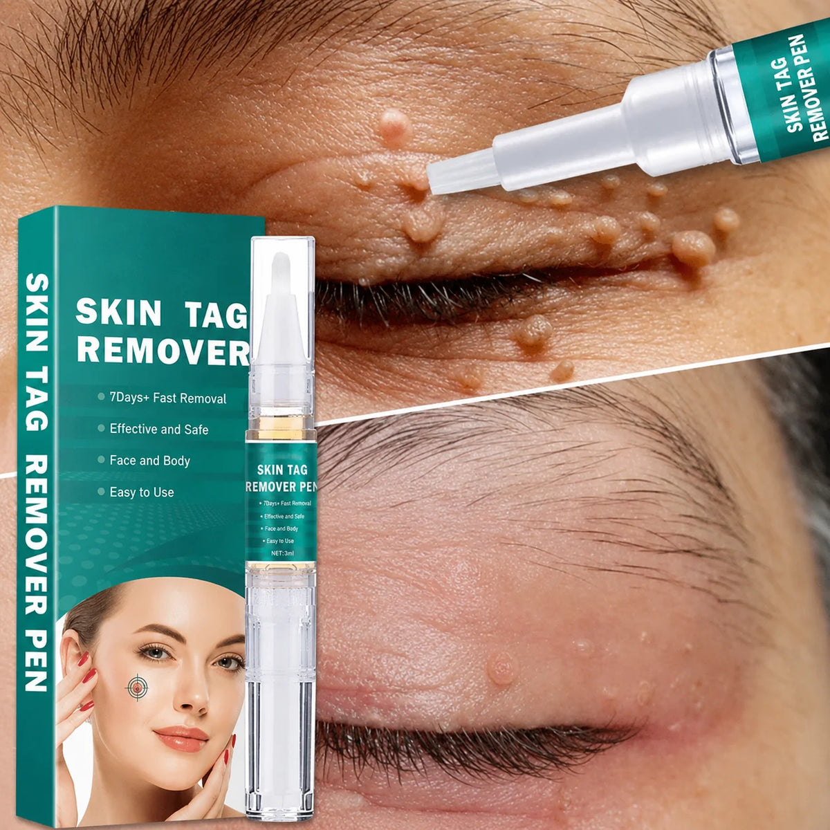 Skin Tag Remover Precision Pen Face & Body