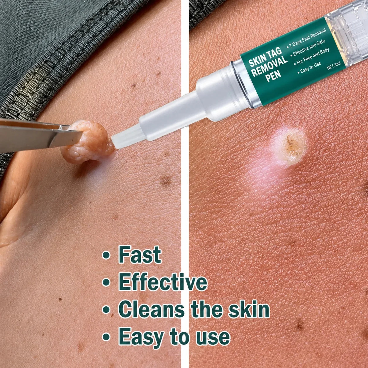 Skin Tag Remover Precision Pen Face & Body