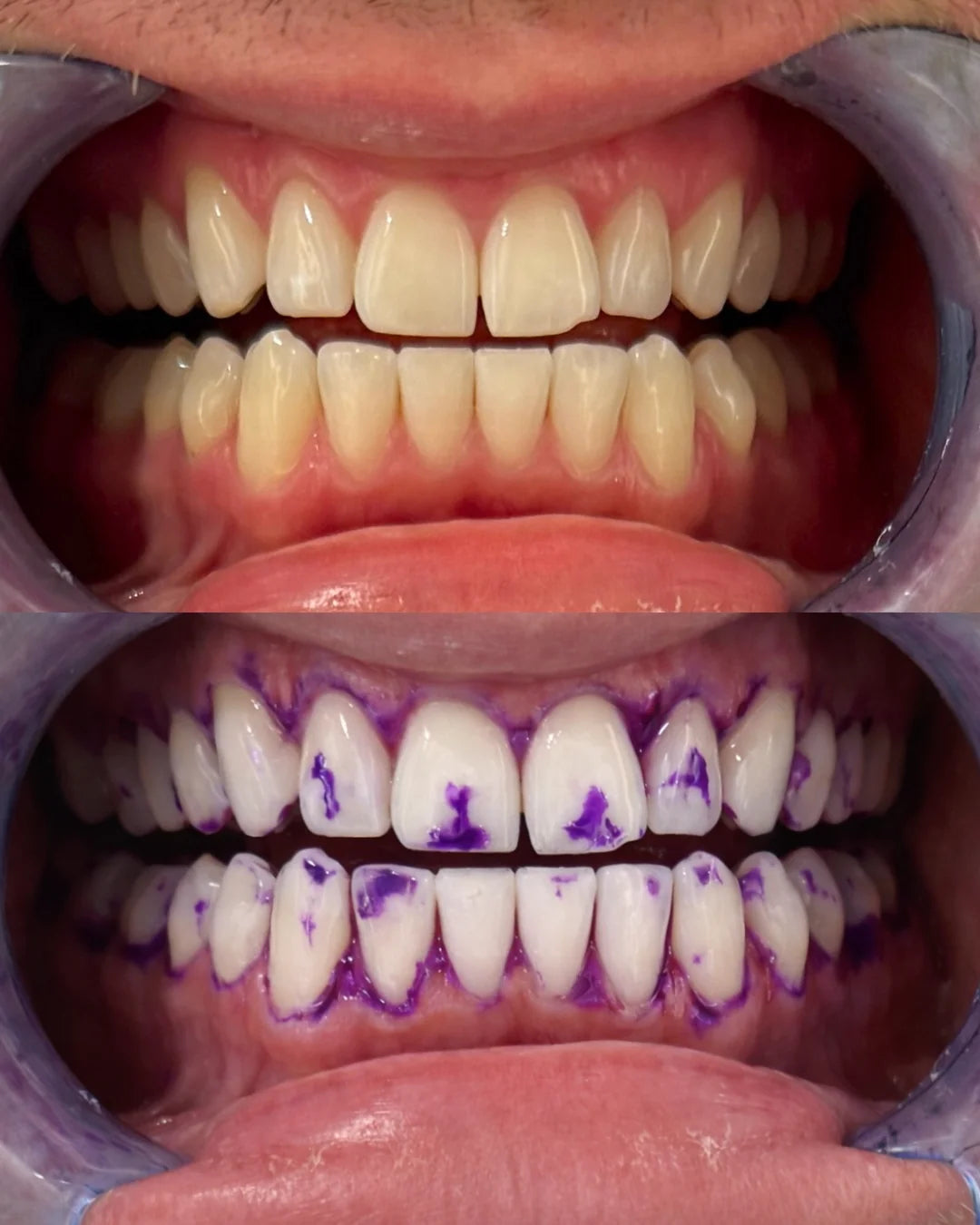 Teeth Whitening Strips Flexible Fit 30-Min Application 14 Pieces